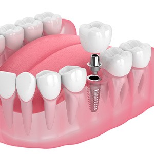 Illustration of a single dental implant