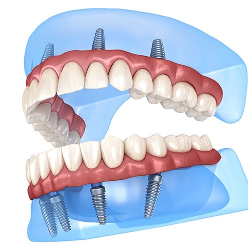 Diagram of angled implant placement in New Baltimore 