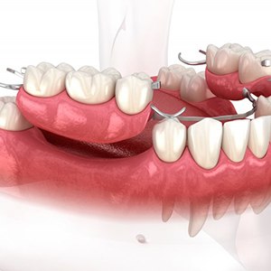 Illustration of partial denture