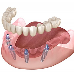 Illustration of implant denture