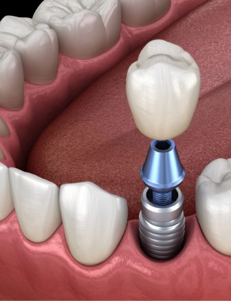 Illustration of a dental crown being placed on a dental implant in the lower jaw
