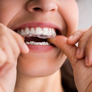 a woman putting clear aligners over her teeth