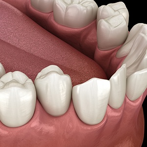 Illustration of crooked teeth