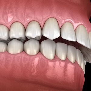 Illustration of an overbite