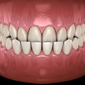 Illustration of an underbite