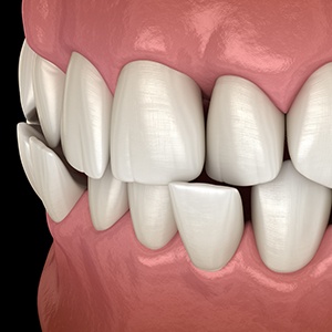 Illustration of a crossbite