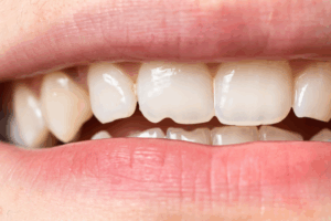 a close-up of a person’s smile with a chipped tooth