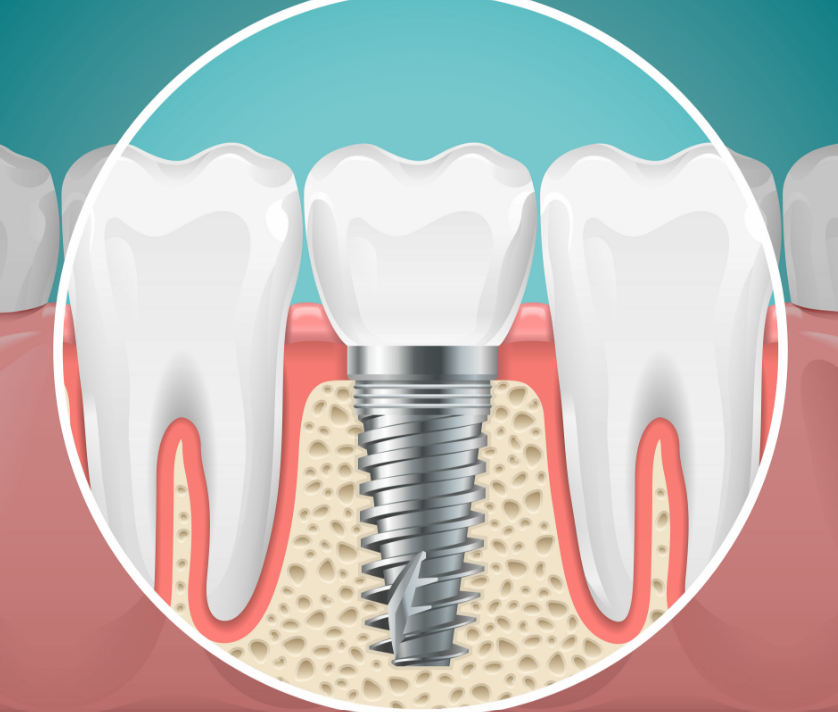 Illustrated cross section of a dental implant